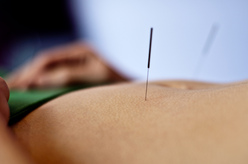Acupuncture needles on body